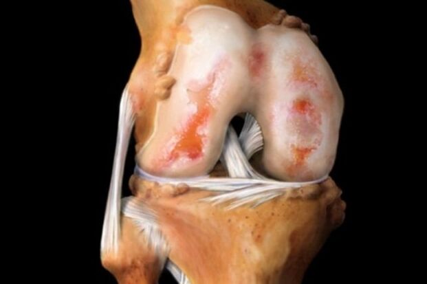 poškození chrupavky při artróze kolene