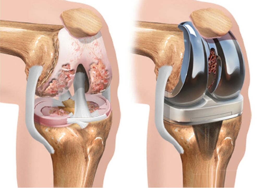 před a po artróze kolenního kloubu pro artrózu