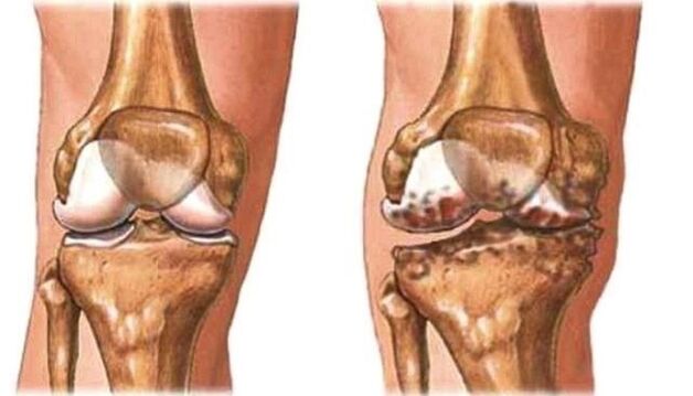 zdravé koleno a kolenní artróza