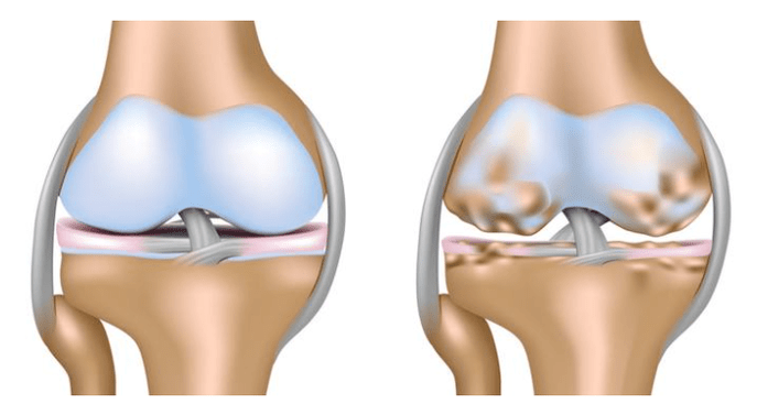 zdravé chrupavky a poškození kolenního kloubu s artrózou