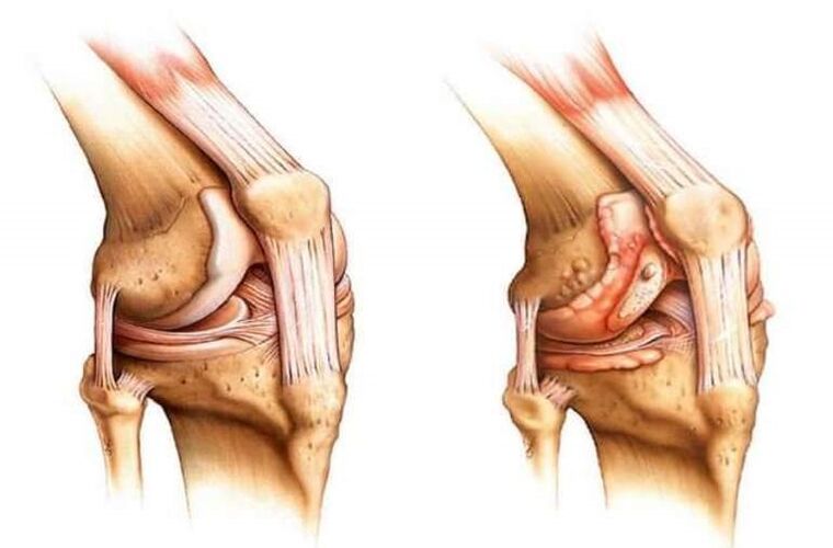 zdravé koleno a artróza kolenního kloubu