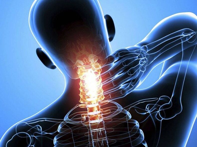 Osteochondróza krční páteře je doprovázena bolestí v krku