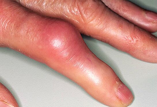 Dna je doprovázena ostrou bolestí v prstech a otoky kloubů. 