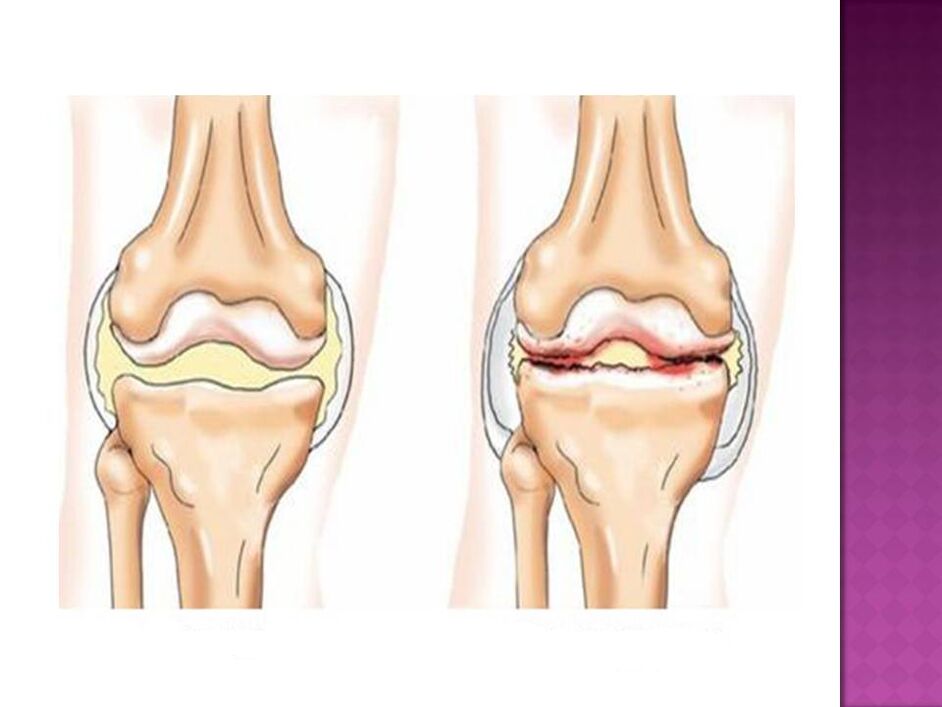 Kloub je normální (vlevo) a postižený osteoartrózou (vpravo)