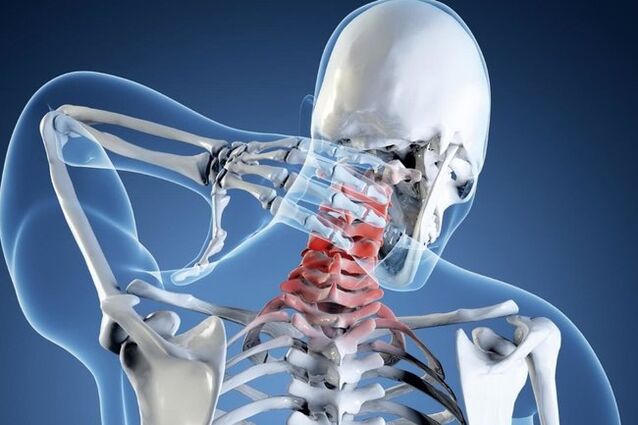 osteochondróza krční páteře